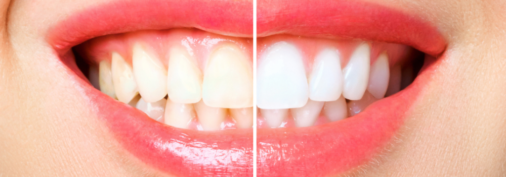 clareamento_dental