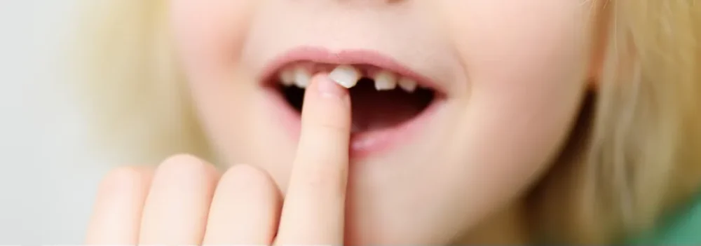 dentes_de_leite