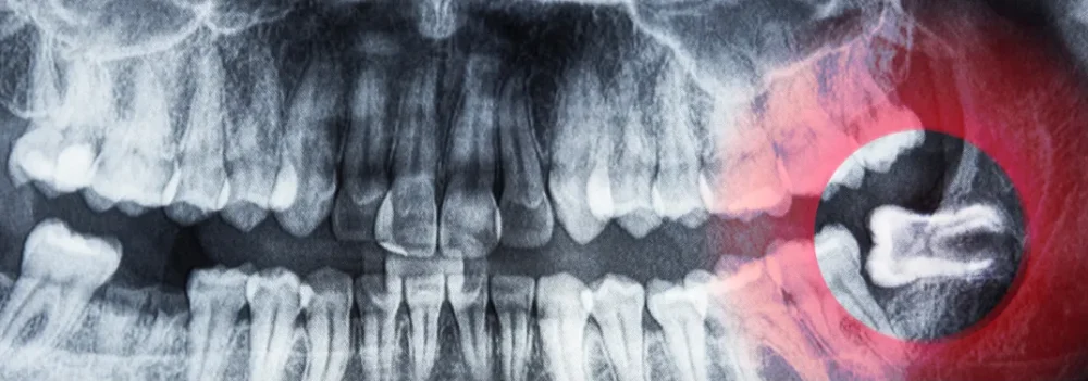 dentes_do_siso