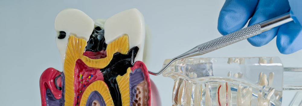 tratamento_de_caries